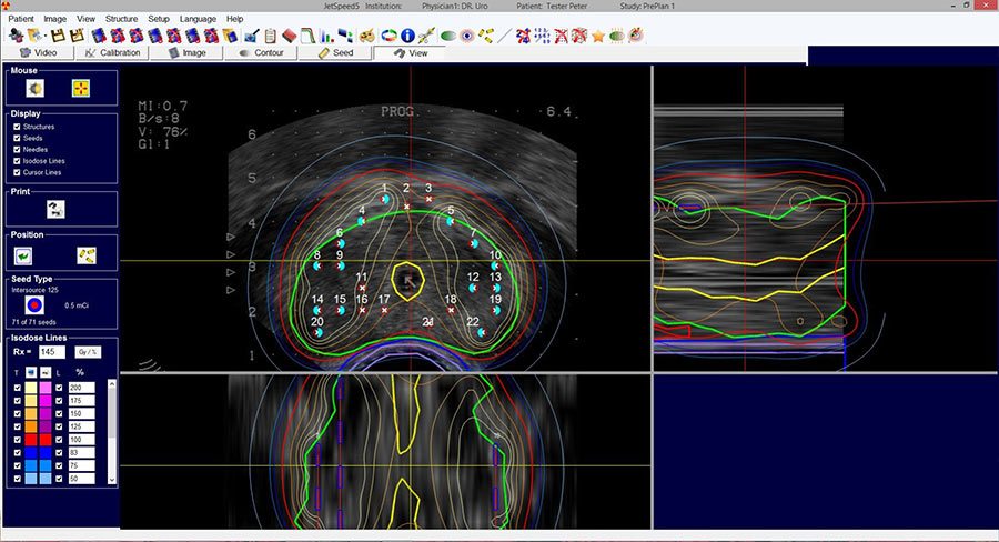 Jetspeed 5 LDR Brachytherapy Planning Software